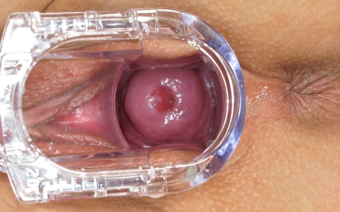 Healthy vagina of a teenager