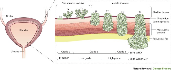 Low GRADE Rumor of the bladder