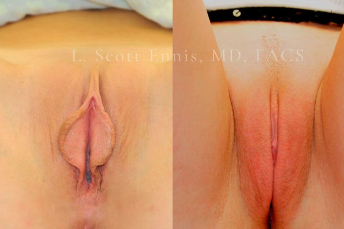 Classification of female vagina