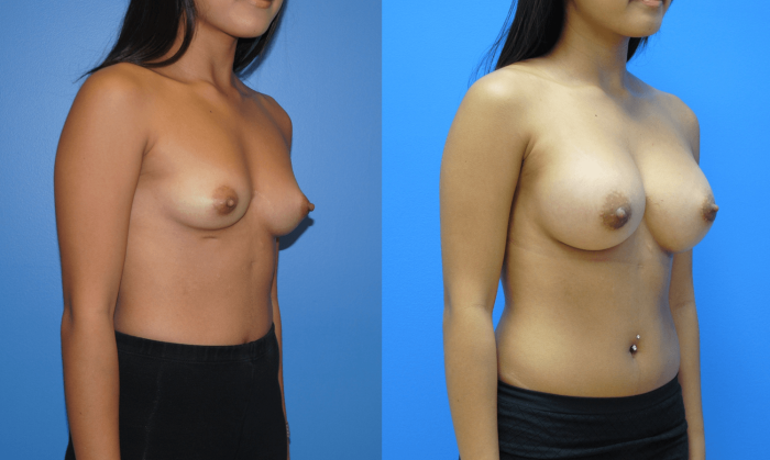 Breast enlargement in Photoshop