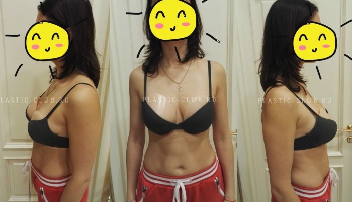 Anatomical implants before and after