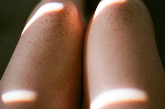 VAIF DELECTION in freckles