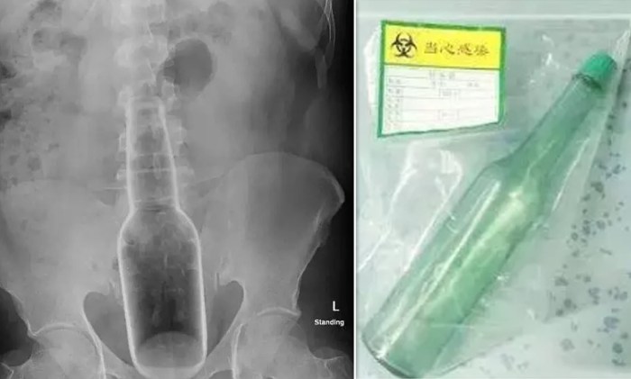A bottle in the rectum