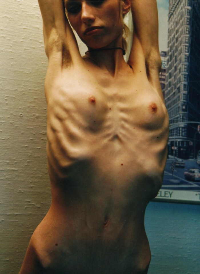 Naked anorexic women