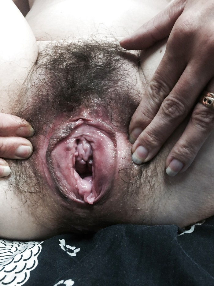 Huge holes of the vagina
