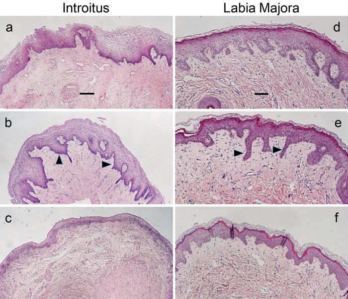 Intriotus in gynecology