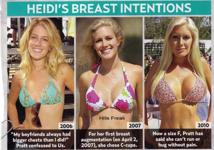Breast enlargement in adulthood