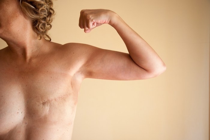 Total Mastectomy