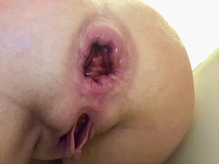 Anal hole of the baby