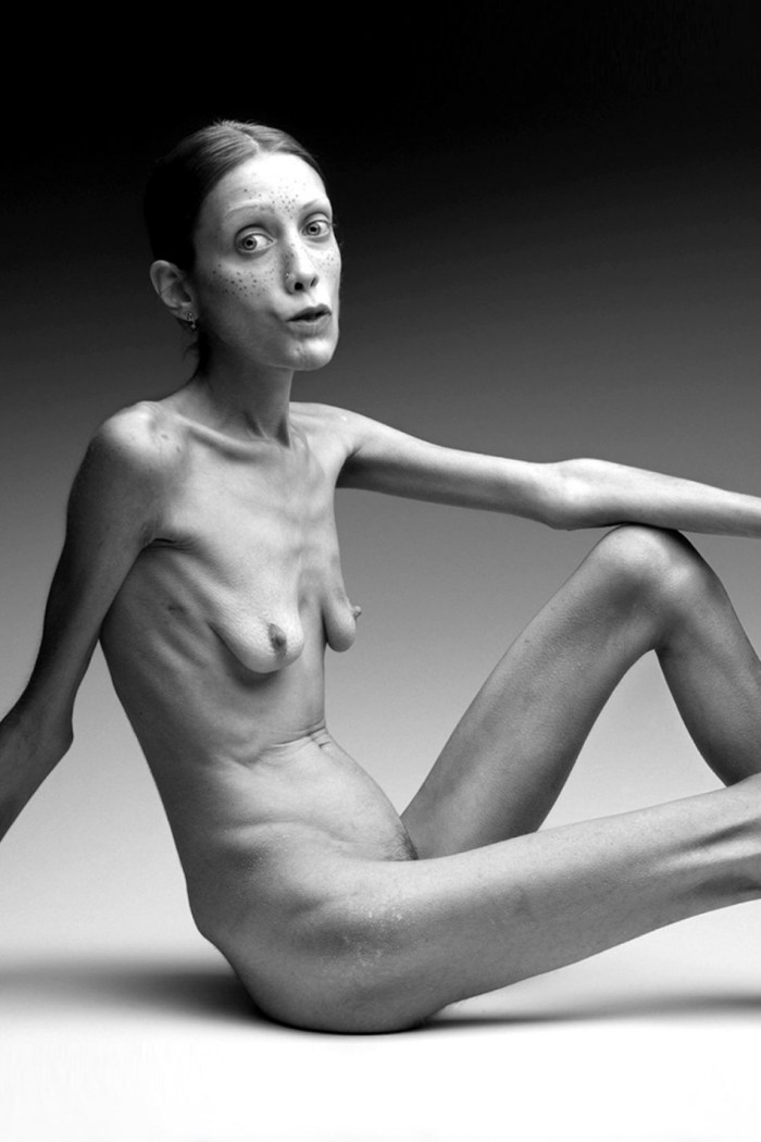 Athletic anorexia