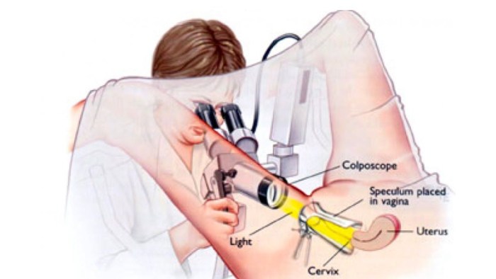 Operation Kolposcopy Gynecology