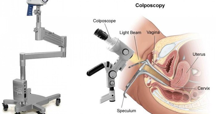 Pathology of the cervix colposcopy