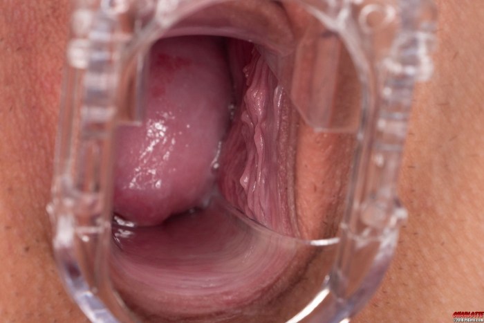 Vaginal beads in vagina