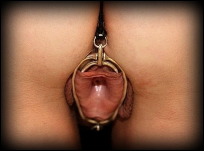 Female circumcision infibulation