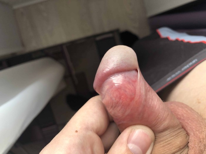 Boy Foresskin Penis Tight Foresskin Puberty Boy
