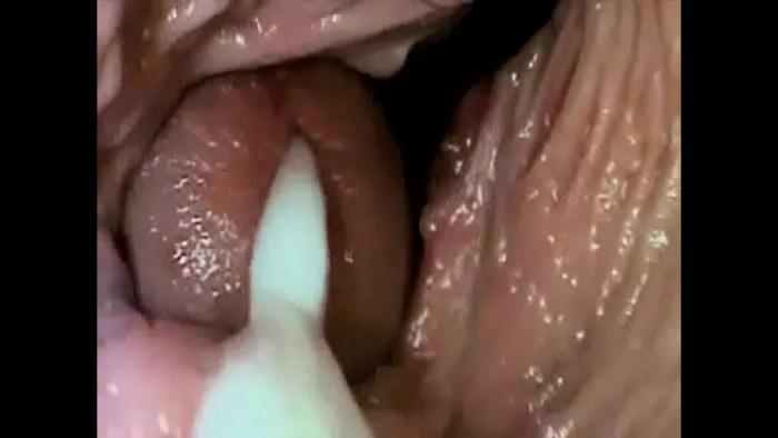 Glass items in a vagina