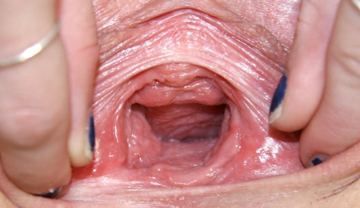 Big hole in the vagina
