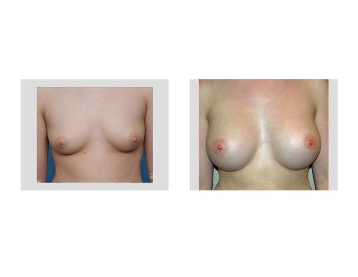 Nude Female Breast Development Puberty photo