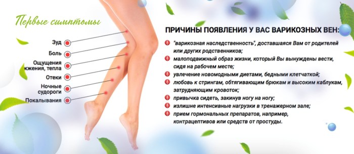 Varicose veins