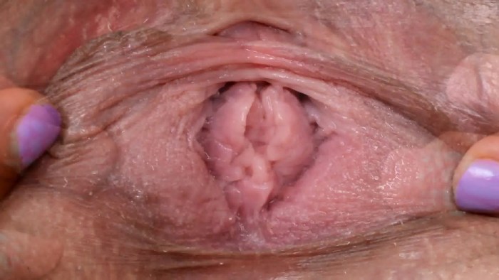Vaginal expander in the vagina