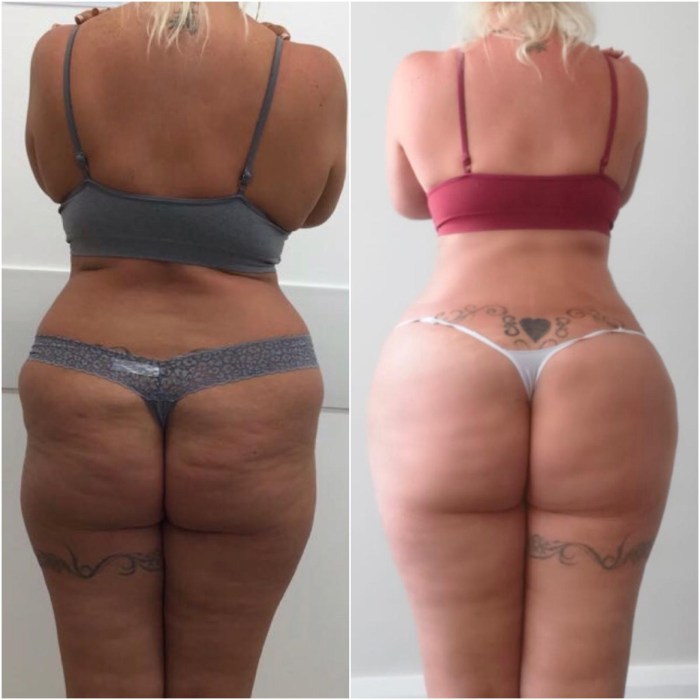 Lipofilling of the buttocks