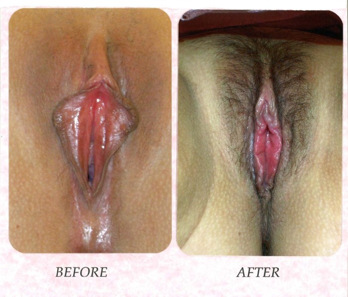 Intimate plastic vagina