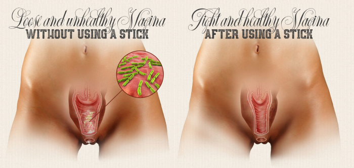 Fertilization of the vagina