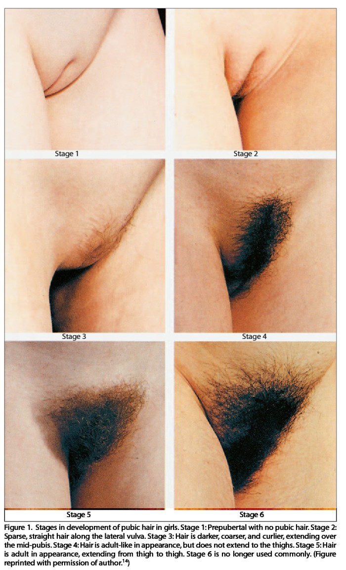 Explification of female pubis