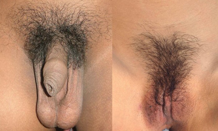 Pubic hair in women