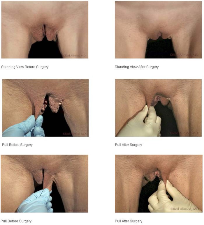 Male penis -cut dick