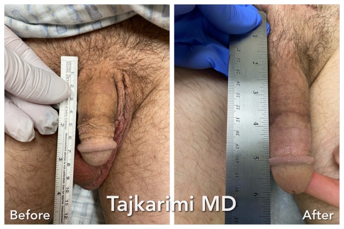 Plastic surgery of penis