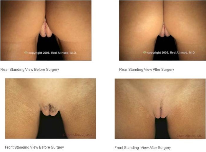 Labioplasty to after