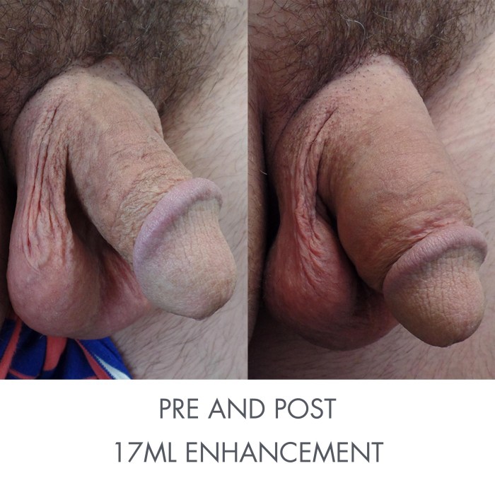 Metidiioplasty vagina
