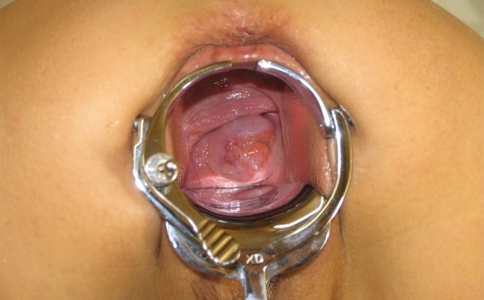 Tested walls of the vagina