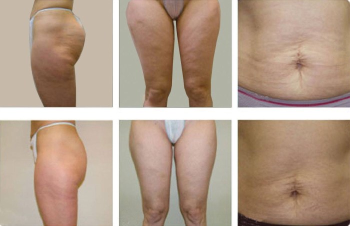 Laser lipolysis cellulite