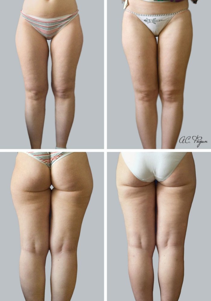 Beautiful ass with cellulite