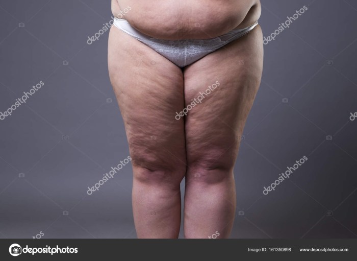Cellulite thick legs