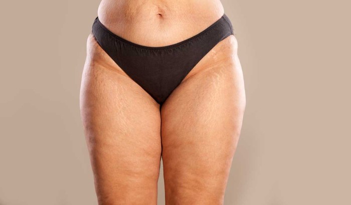Creative advertising of weight loss