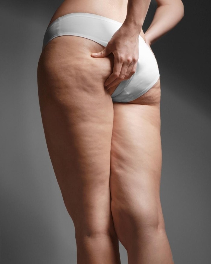 Cellulite on the hands before after