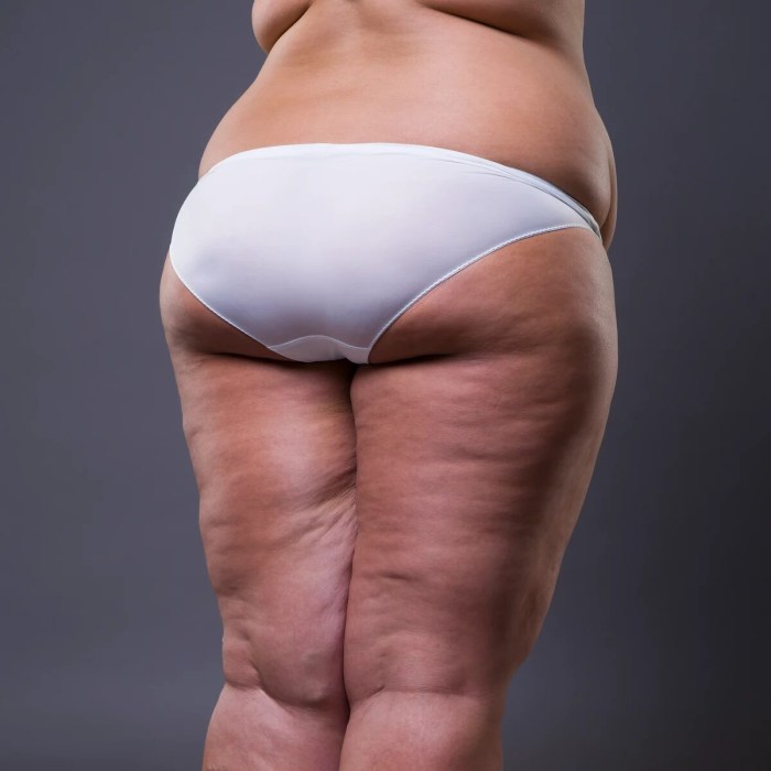 Naked cellulite hairy