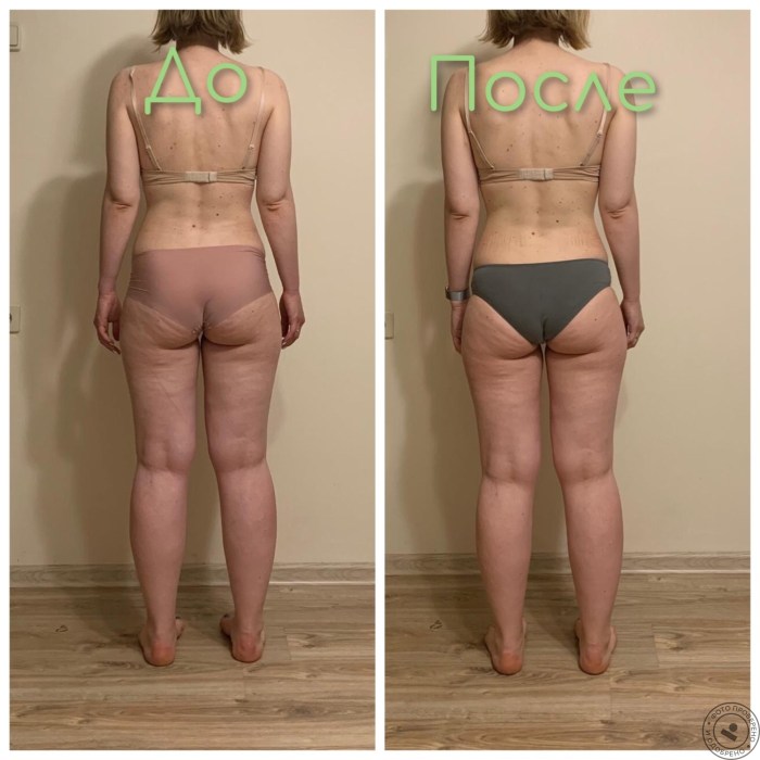 Lymphatic drainage massage before and