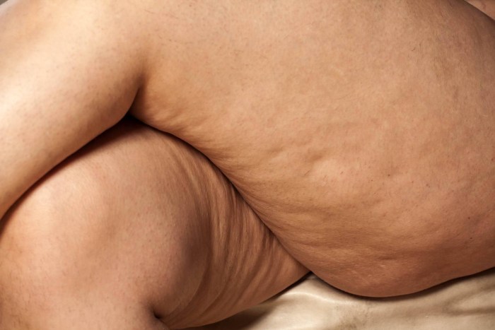 Cellulite thick legs