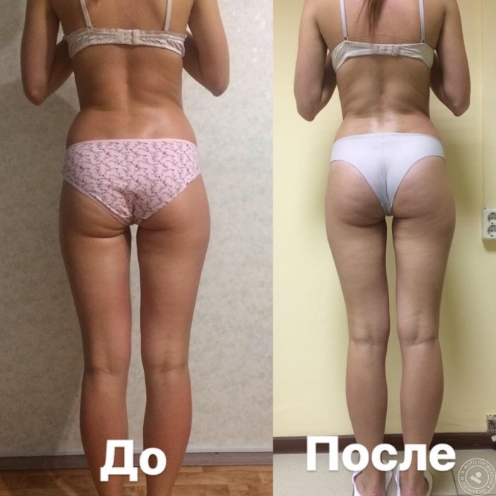 Huge fat hips
