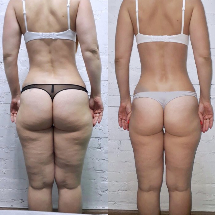 LPG massage before and after