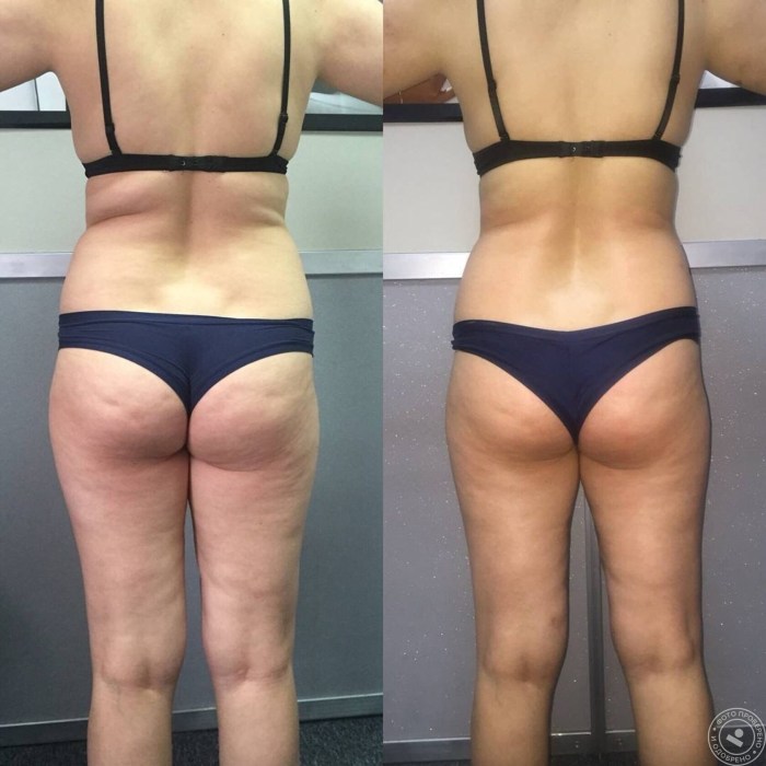 Lymphodnate massage before and after