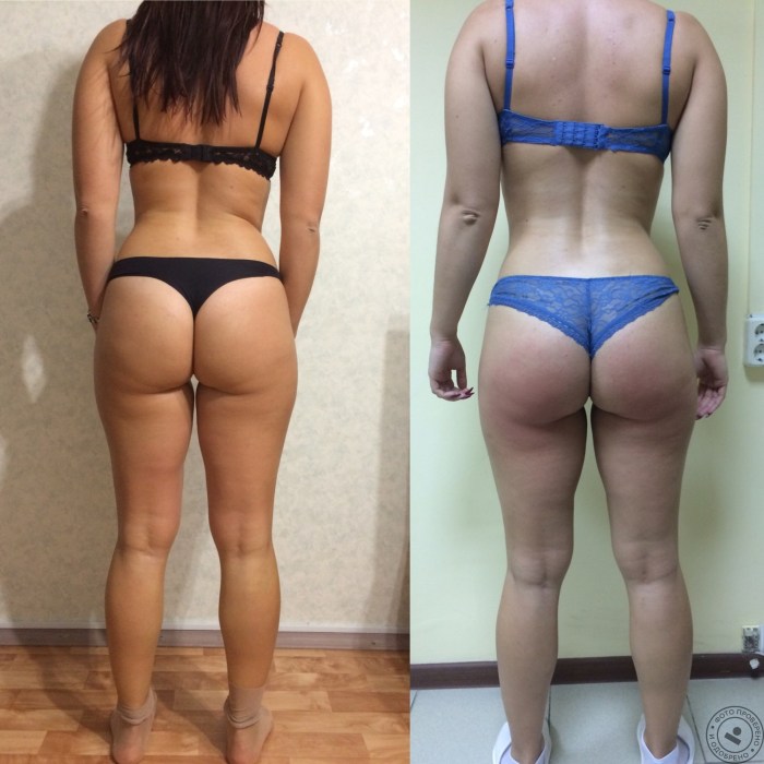Fat cellulite women