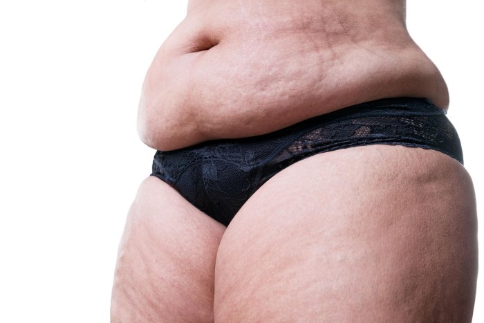 Fat cellulite belly