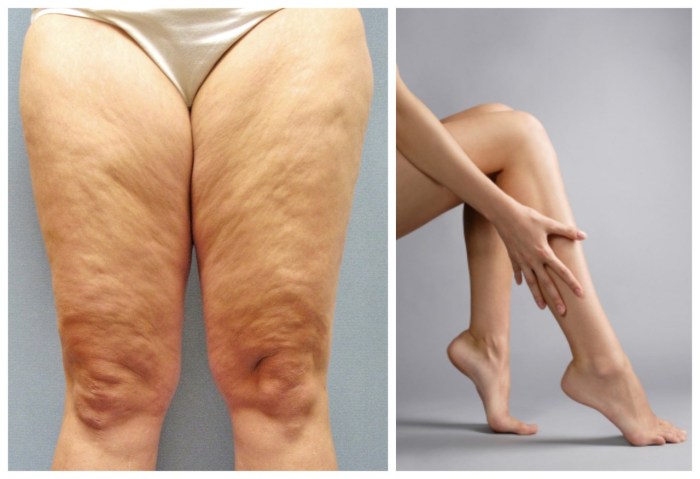 Anti -cellulite massage promotion