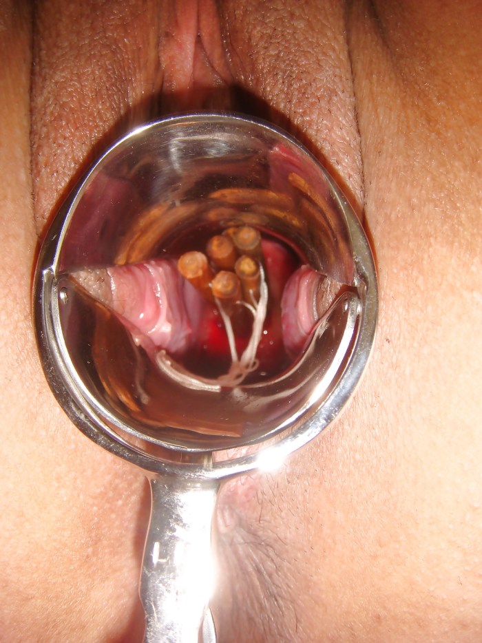 Widely open vagina uterus
