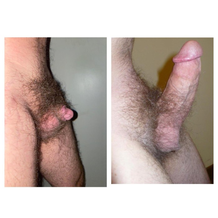 Pathological erection
